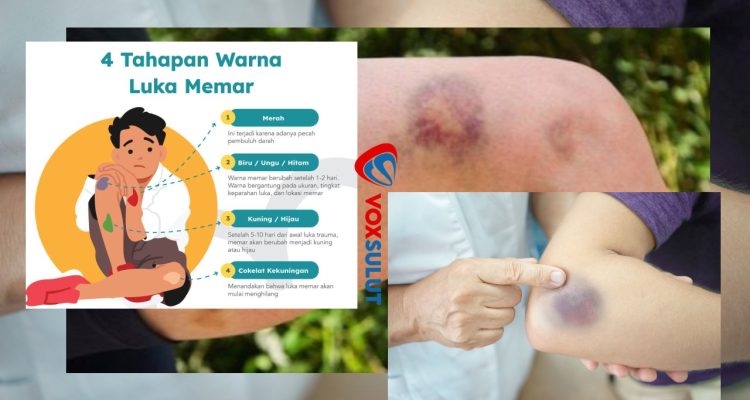 Penyebab dan Gejala Memar, Kenali & apa yang Perlu Diwaspadai