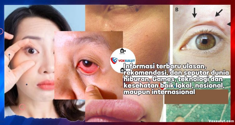 Mata Sering Berkedip, Benarkah Tanda Cacingan