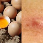 Benarkah Makan Banyak Telur Bisa Menyebabkan Bisulan?
