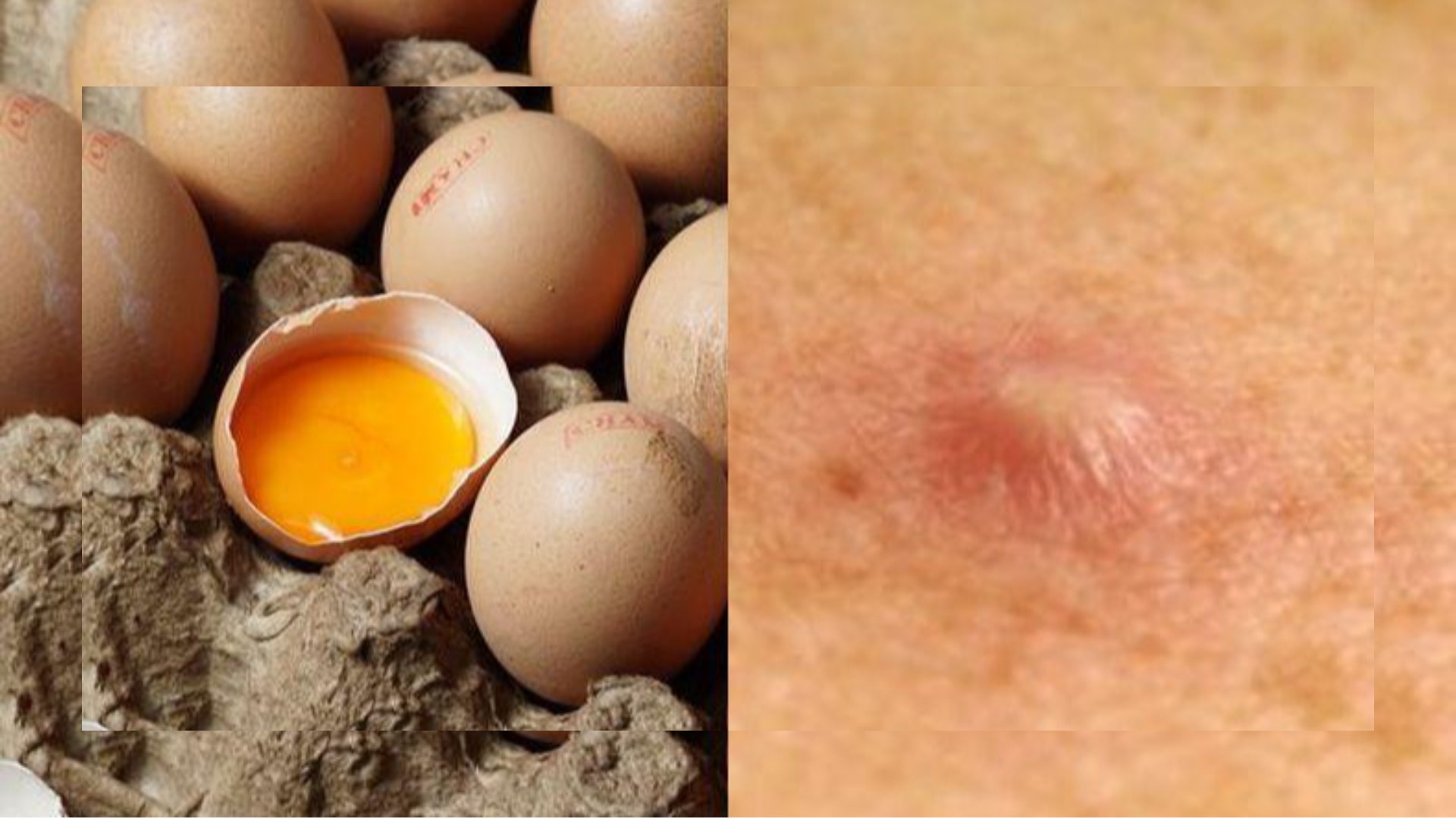 Benarkah Makan Banyak Telur Bisa Menyebabkan Bisulan?