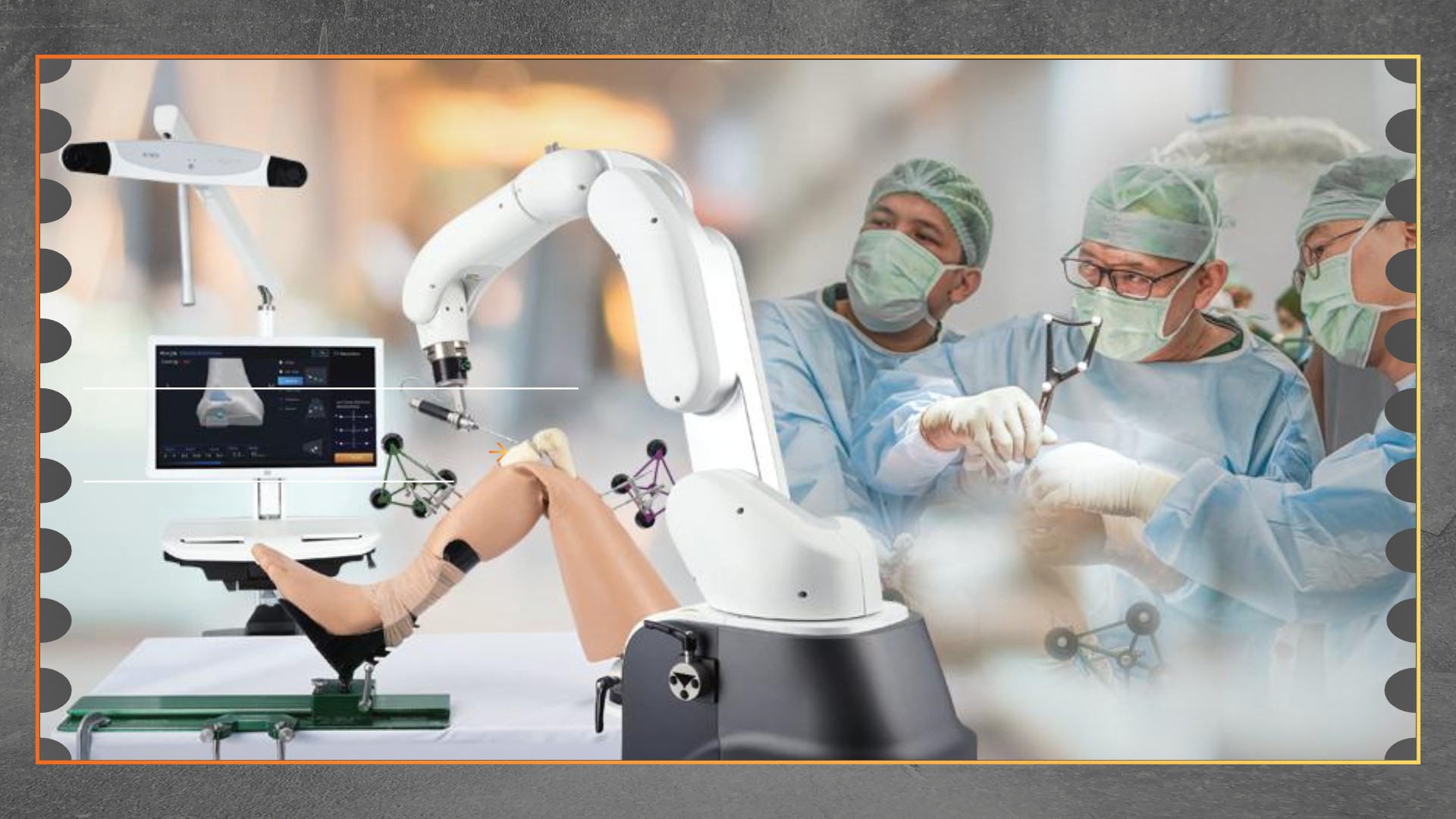 Mengenal Robotic TKR, Operasi Penggantian Sendi Lutut