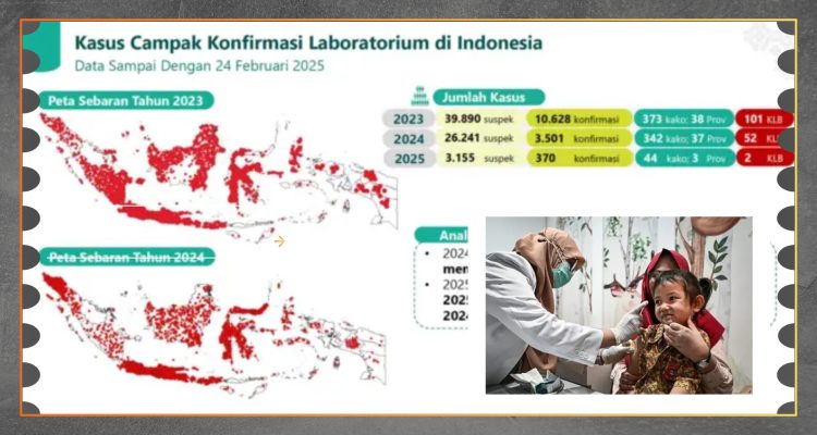 Lonjakan Kasus Campak Peran Data dan Teknologi Kesehatan